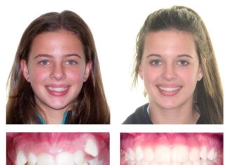 Этапы ортодонтического лечения Этапы ортодонтического лечения