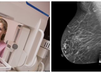 Искусственный интеллект в маммографии Искусственный интеллект в маммографии