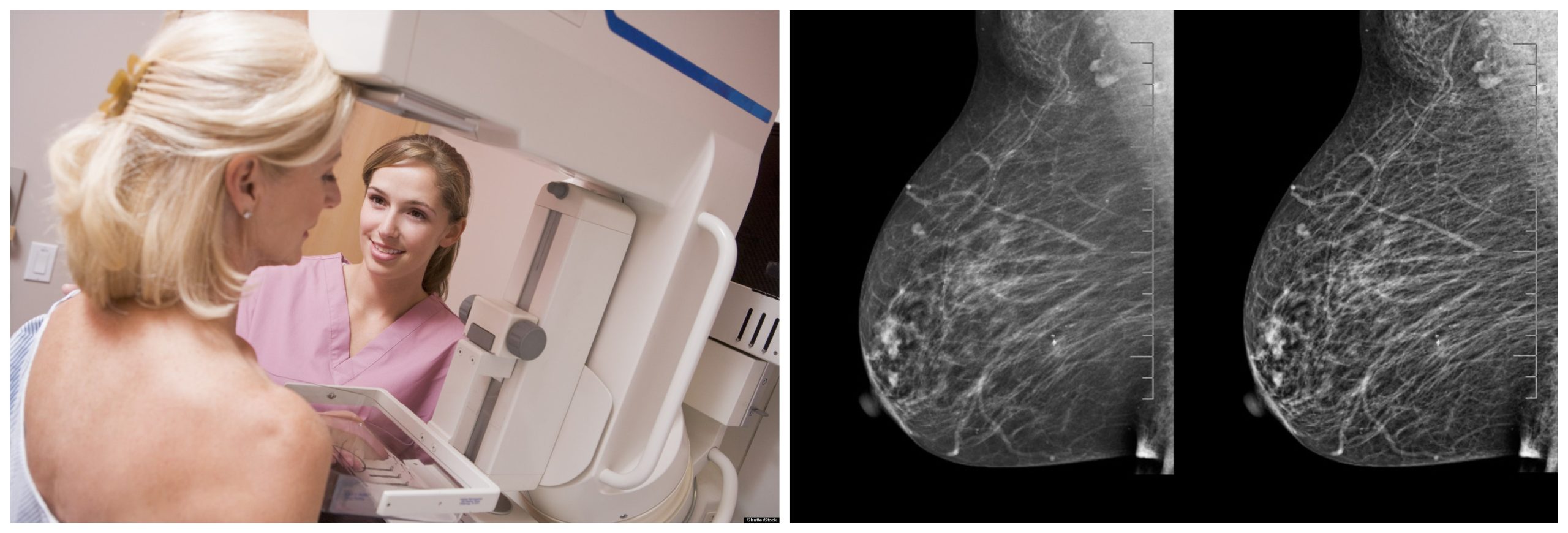 как делают маммографию груди у женщин фото 30
