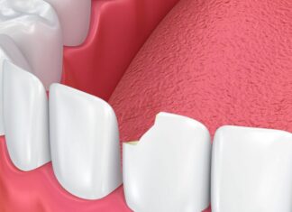 Причины возникновения сколов на зубах Причины возникновения сколов на зубах