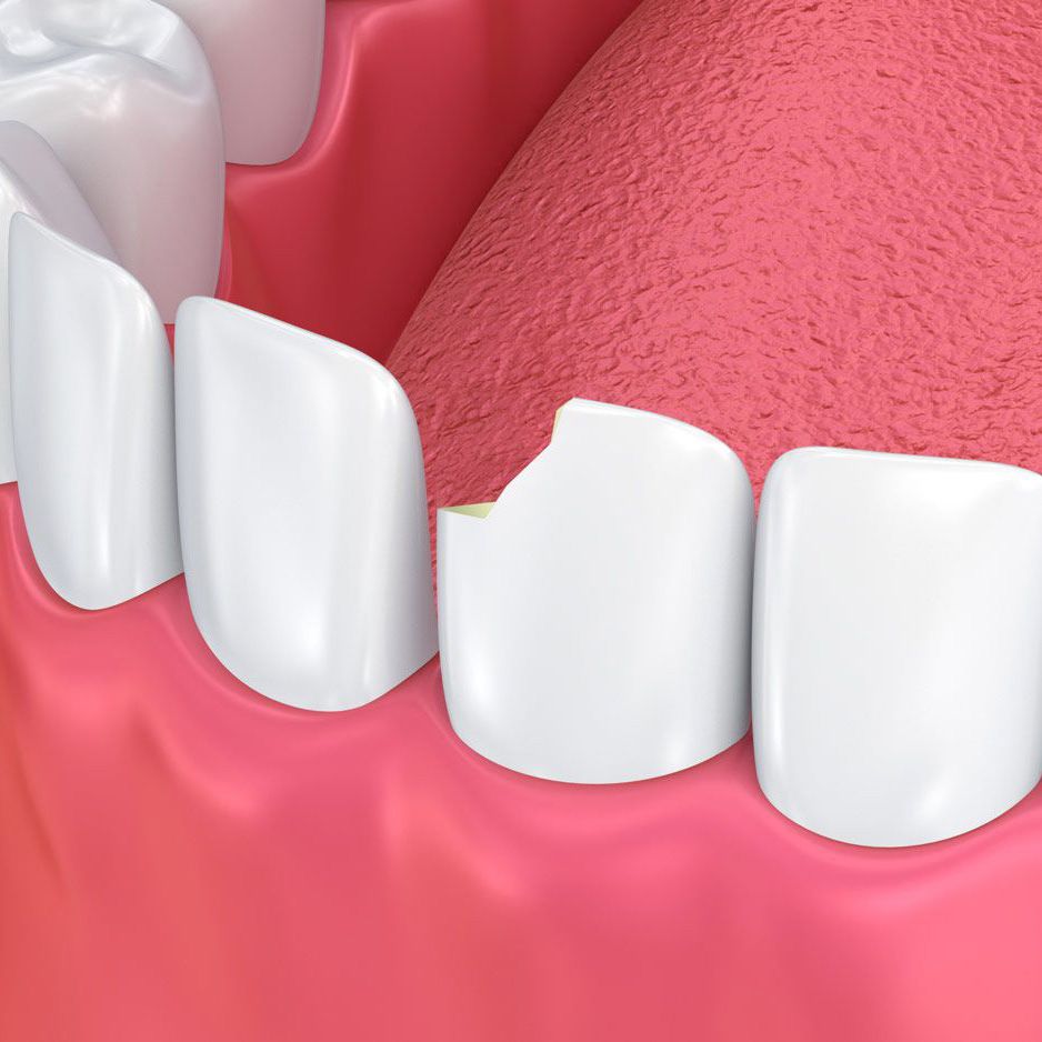 Причины возникновения сколов на зубах