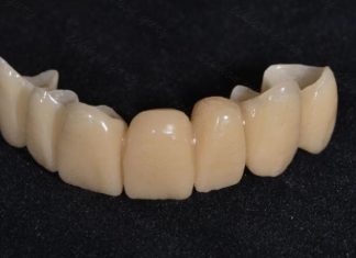 Что такое временная коронка и как правильно выбрать клинику?