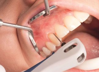 Современные подходы в лечении пародонтита