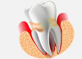 Периодонтит: как бороться и предотвратить