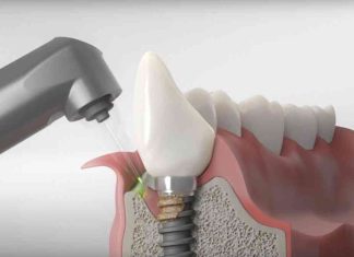 Что такое периимплантит и как лечить