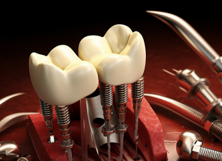 Имплантация зубов: новые технологии установки имплантов